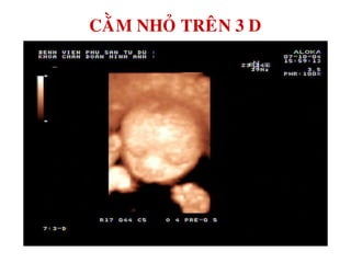 CAÈM NHOÛ TREÂN 3 D
 