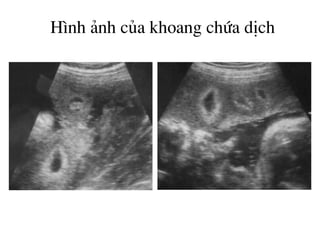 H×nh ¶nh cña khoang chøa dÞch
 