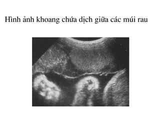 H×nh ¶nh khoang chøa dÞch gi÷a c¸c mói rau
 
