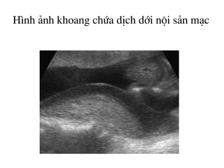 H×nh ¶nh khoang chøa dÞch díi néi s¶n m¹c
 