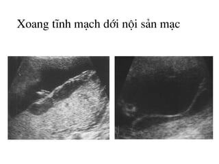 Xoang tÜnh m¹ch díi néi s¶n m¹c
 