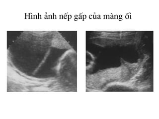 H×nh ¶nh nÕp gÊp cña mµng èi
 