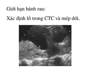 Giíi h¹n b¸nh rau:
X¸c ®Þnh lç trong CTC vµ mÐp díi.
 