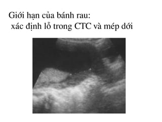 Giíi h¹n cña b¸nh rau:
x¸c ®Þnh lç trong CTC vµ mÐp díi
 