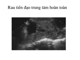 Rau tiÒn ®¹o trung t©m hoµn toµn
 