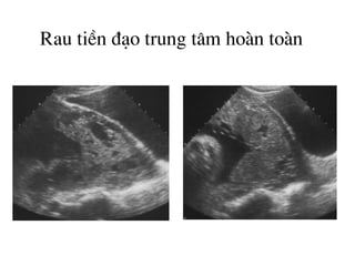 Rau tiÒn ®¹o trung t©m hoµn toµn
 