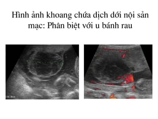 H×nh ¶nh khoang chøa dÞch díi néi s¶n
m¹c: Ph©n biÖt víi u b¸nh rau
 