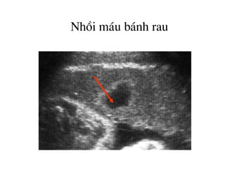 Nhåi m¸u b¸nh rau
 