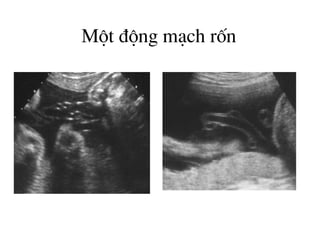 Mét ®éng m¹ch rèn
 