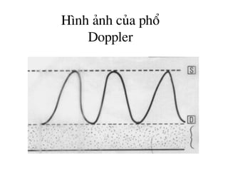 H×nh ¶nh cña phæ
Doppler
 