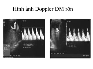 H×nh ¶nh Doppler §M rèn
 