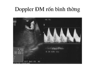 Doppler §M rèn b×nh thêng
 