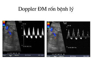 Doppler §M rèn bÖnh lý
 