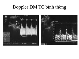 Doppler §M TC b×nh thêng
 