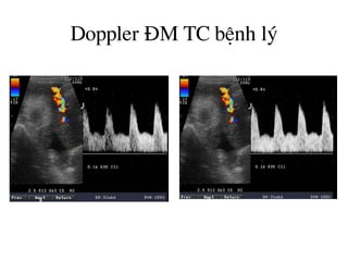 Doppler §M TC bÖnh lý
 