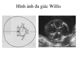 H×nh ¶nh ®a gi¸c Willis
 