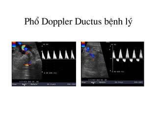 Phæ Doppler Ductus bÖnh lý
 