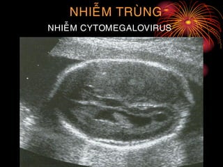 NHIEÃM TRUØNG
NHIEÃM CYTOMEGALOVIRUS
 