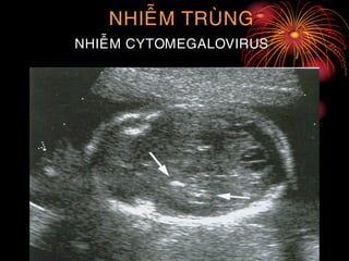 NHIEÃM TRUØNG
NHIEÃM CYTOMEGALOVIRUS
 