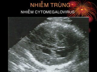 NHIEÃM TRUØNG
NHIEÃM CYTOMEGALOVIRUS
 