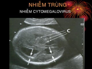 NHIEÃM TRUØNG
NHIEÃM CYTOMEGALOVIRUS
 
