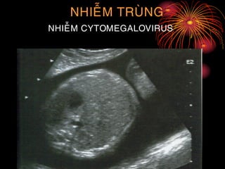 NHIEÃM TRUØNG
NHIEÃM CYTOMEGALOVIRUS
 