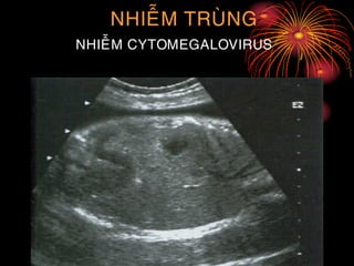 NHIEÃM TRUØNG
NHIEÃM CYTOMEGALOVIRUS
 