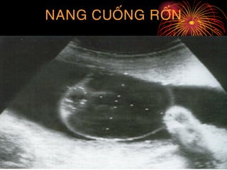 NANG CUOÁNG ROÁN
 