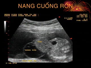 NANG CUOÁNG ROÁN
 