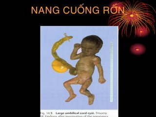 NANG CUOÁNG ROÁN
 