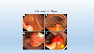 Endoscopia de pólipos
 
