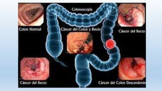 CÁNCER DE COLON
