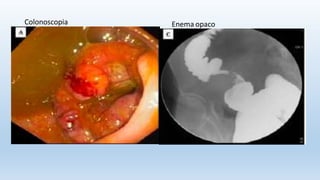 Colonoscopia Enema opaco
 