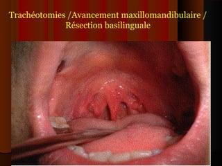 Trachéotomies /Avancement maxillomandibulaire /
Résection basilinguale
 