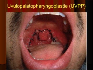 Uvulopalatopharyngoplastie (UVPP)
 