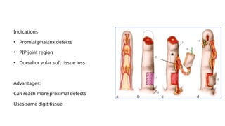 Pip Volar Injection Comprehensive Management of Fingertip and Nailbed Injuries: Techniques ...