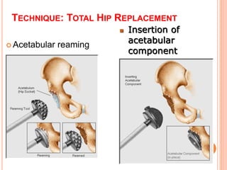 Total joint replacement surgeries | PPT