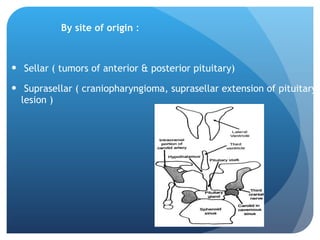 By site of origin  :  Sellar ( tumors of anterior & posterior pituitary) Suprasellar ( craniopharyngioma, suprasellar extension of pituitary lesion ) 
