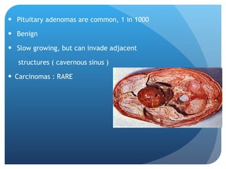 Pituitary adenomas are common, 1 in 1000 Benign Slow growing, but can invade adjacent  structures ( cavernous sinus ) Carcinomas : RARE 