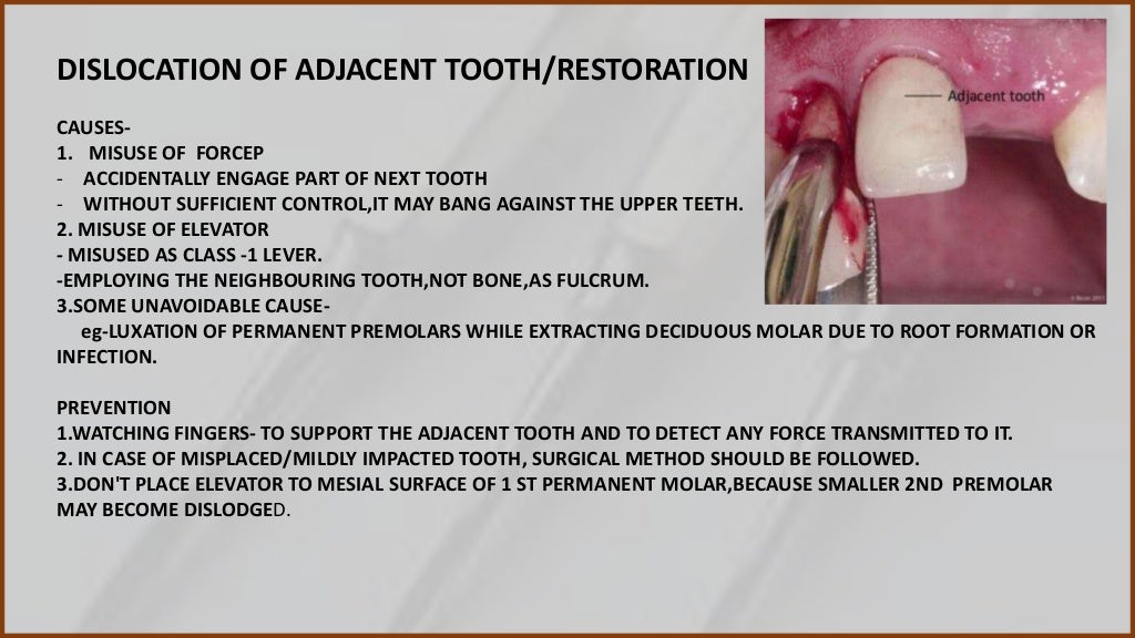 Complication of Tooth extraction and management
