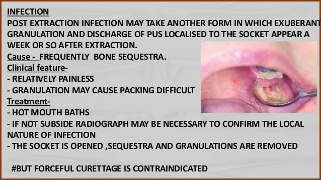 Complication Of Tooth Extraction And Management