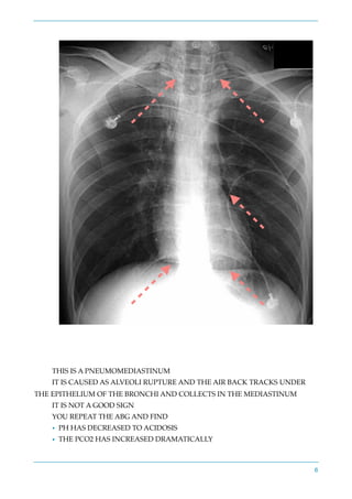 THIS IS A PNEUMOMEDIASTINUM
IT IS CAUSED AS ALVEOLI RUPTURE AND THE AIR BACK TRACKS UNDER
THE EPITHELIUM OF THE BRONCHI AND COLLECTS IN THE MEDIASTINUM
IT IS NOT A GOOD SIGN
YOU REPEAT THE ABG AND FIND
• PH HAS DECREASED TO ACIDOSIS
• THE PCO2 HAS INCREASED DRAMATICALLY
6
 