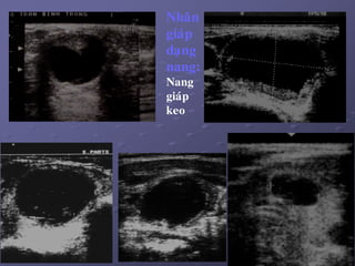 20
Nhaân
giaùp
daïng
nang:
Nang
giaùp
keo
 