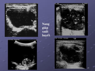 21
Nang
giaùp
xuaát
huyeát
 