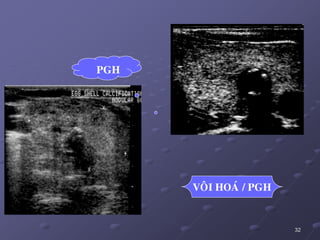 32
PGH
VOÂI HOAÙ / PGH
 