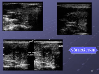 33
VOÂI HOAÙ / PGH
 