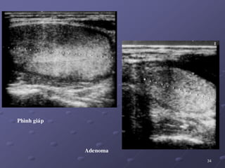 34
Phình giaùp
Adenoma
 