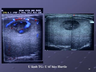 36
U laønh TG: U teá baøo Hurtle
 