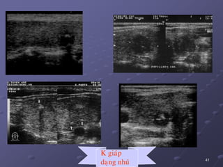 41
K giaùp
daïng nhuù
 