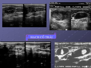 44
HAÏCH COÅ TRAÙI
 